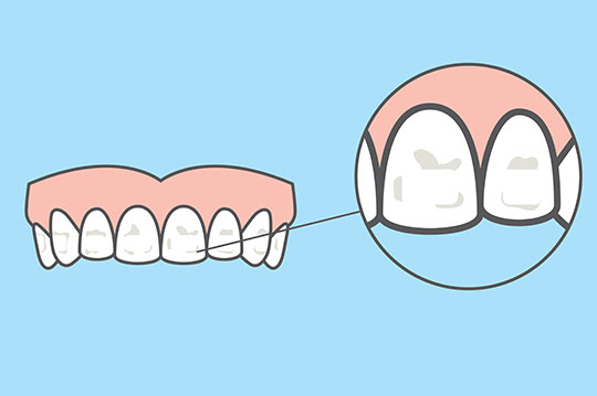 انواع لکه های ی دندان و عوامل ایجاد آن